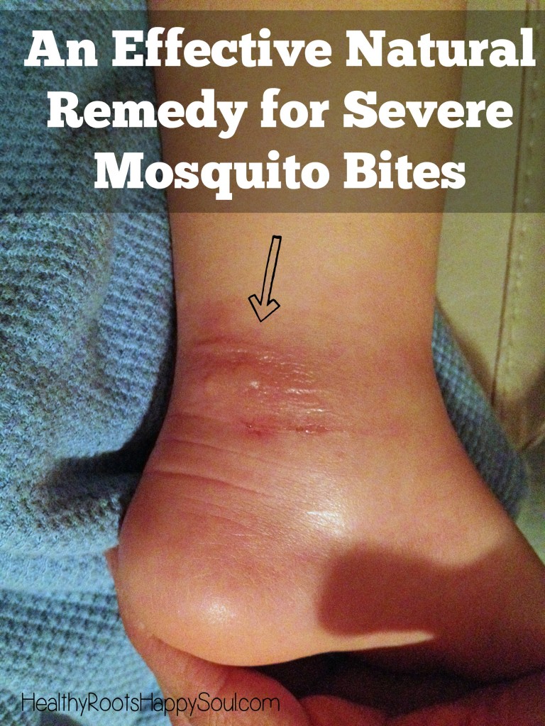 Severe mosquito bites are no joke. Read this story of a mom who finally found her son an effective, natural remedy for severe mosquito bites.